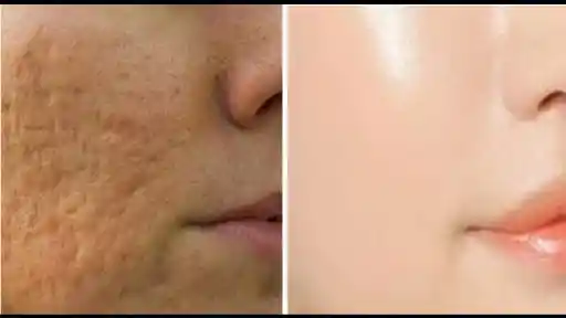 Home remedy to get rid of open pores in skin..